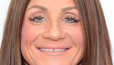 Before - Natural Smiles Implant & Cosmetic Dentistry