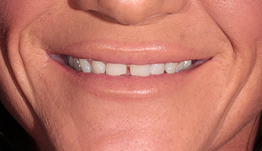 Before - Natural Smiles Implant & Cosmetic Dentistry