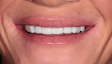 After - Natural Smiles Implant & Cosmetic Dentistry