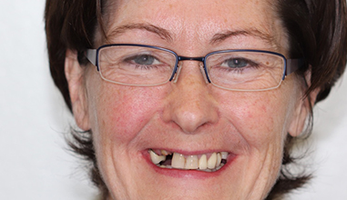Before - Natural Smiles Implant & Cosmetic Dentistry