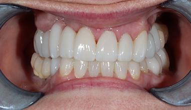 After - Natural Smiles Implant & Cosmetic Dentistry