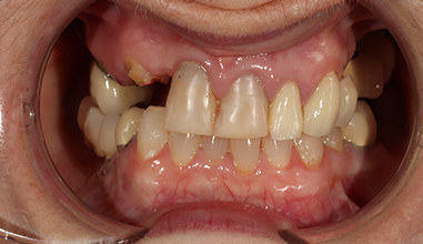 Before - Natural Smiles Implant & Cosmetic Dentistry