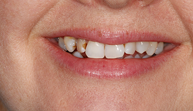 Before - Natural Smiles Implant & Cosmetic Dentistry