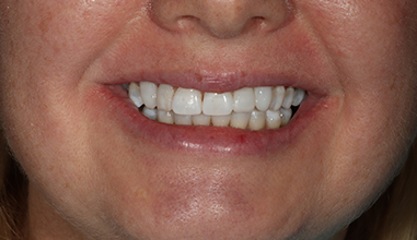 After - Natural Smiles Implant & Cosmetic Dentistry
