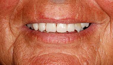 After - Natural Smiles Implant & Cosmetic Dentistry