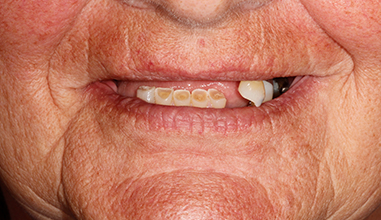 Before - Natural Smiles Implant & Cosmetic Dentistry
