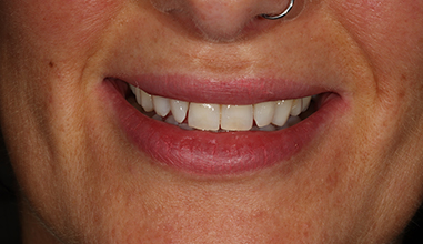 Before - Natural Smiles Implant & Cosmetic Dentistry