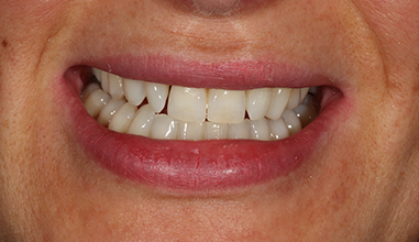 Before - Natural Smiles Implant & Cosmetic Dentistry