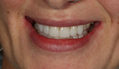 After - Natural Smiles Implant & Cosmetic Dentistry