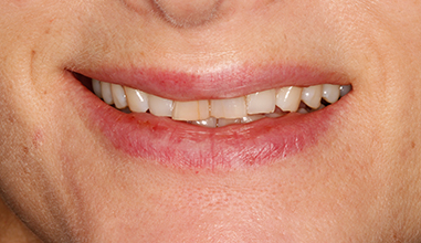 Before - Natural Smiles Implant & Cosmetic Dentistry