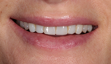 After - Natural Smiles Implant & Cosmetic Dentistry