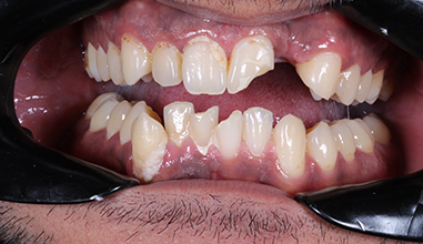 Before - Natural Smiles Implant & Cosmetic Dentistry