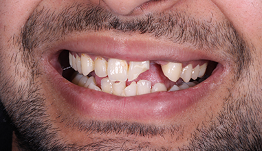 Before - Natural Smiles Implant & Cosmetic Dentistry
