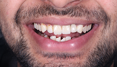 After - Natural Smiles Implant & Cosmetic Dentistry