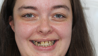 Before - Natural Smiles Implant & Cosmetic Dentistry