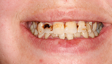 Before - Natural Smiles Implant & Cosmetic Dentistry