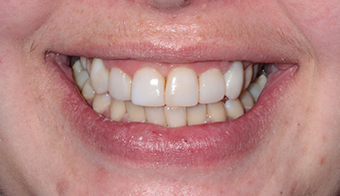 After - Natural Smiles Implant & Cosmetic Dentistry