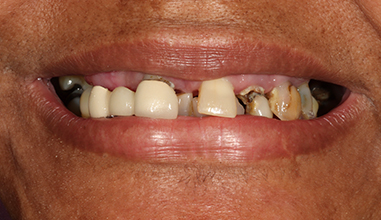 Before - Natural Smiles Implant & Cosmetic Dentistry