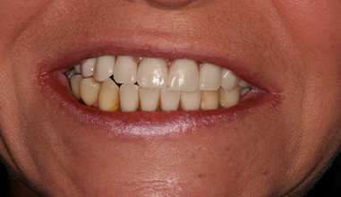 After - Natural Smiles Implant & Cosmetic Dentistry