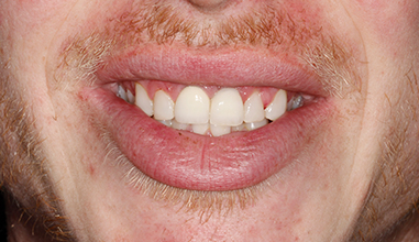 After - Natural Smiles Implant & Cosmetic Dentistry