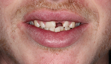 Before - Natural Smiles Implant & Cosmetic Dentistry