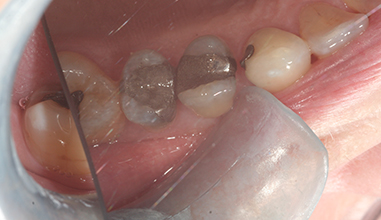 Before - Natural Smiles Implant & Cosmetic Dentistry