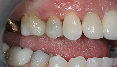 After - Natural Smiles Implant & Cosmetic Dentistry