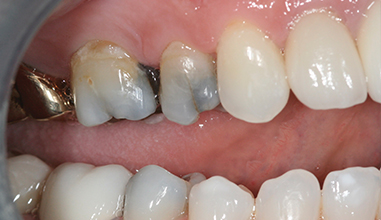 Before - Natural Smiles Implant & Cosmetic Dentistry