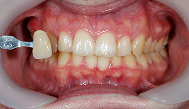 Before - Natural Smiles Implant & Cosmetic Dentistry