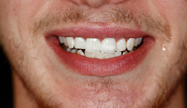 After - Natural Smiles Implant & Cosmetic Dentistry