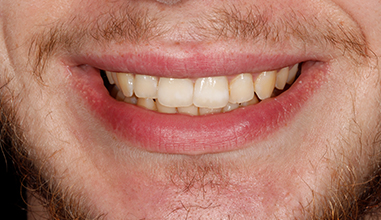 Before - Natural Smiles Implant & Cosmetic Dentistry