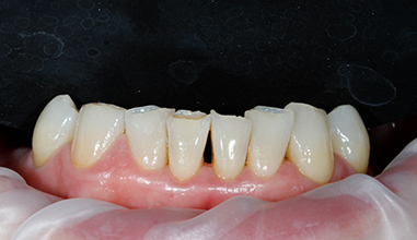 Before - Natural Smiles Implant & Cosmetic Dentistry
