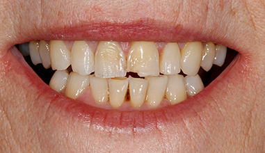 Before - Natural Smiles Implant & Cosmetic Dentistry