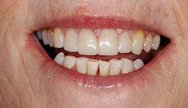 After - Natural Smiles Implant & Cosmetic Dentistry