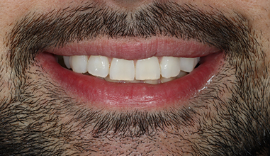 Before - Natural Smiles Implant & Cosmetic Dentistry