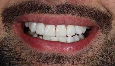 After - Natural Smiles Implant & Cosmetic Dentistry