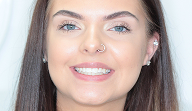 Before - Natural Smiles Implant & Cosmetic Dentistry