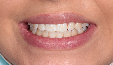Before - Natural Smiles Implant & Cosmetic Dentistry
