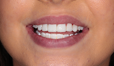 After - Natural Smiles Implant & Cosmetic Dentistry
