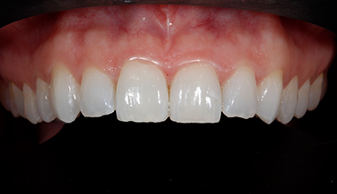 Before - Natural Smiles Implant & Cosmetic Dentistry