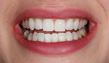 Before - Natural Smiles Implant & Cosmetic Dentistry