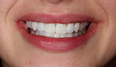 After - Natural Smiles Implant & Cosmetic Dentistry