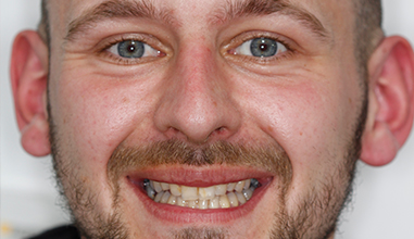Before - Natural Smiles Implant & Cosmetic Dentistry