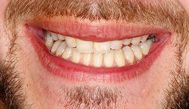 Before - Natural Smiles Implant & Cosmetic Dentistry