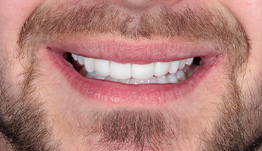 After - Natural Smiles Implant & Cosmetic Dentistry