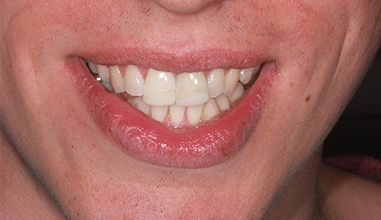 Before - Natural Smiles Implant & Cosmetic Dentistry