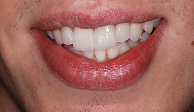 After - Natural Smiles Implant & Cosmetic Dentistry