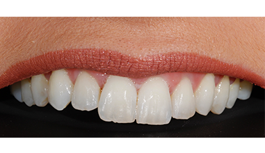 Before - Natural Smiles Implant & Cosmetic Dentistry