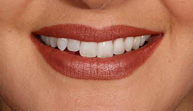 Before - Natural Smiles Implant & Cosmetic Dentistry