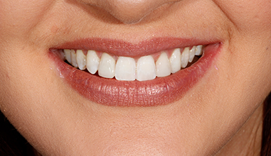 After - Natural Smiles Implant & Cosmetic Dentistry